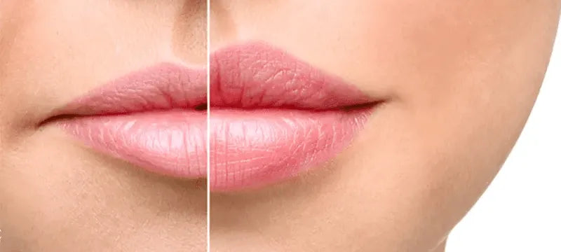 $99 Zoom Lip Filler Class